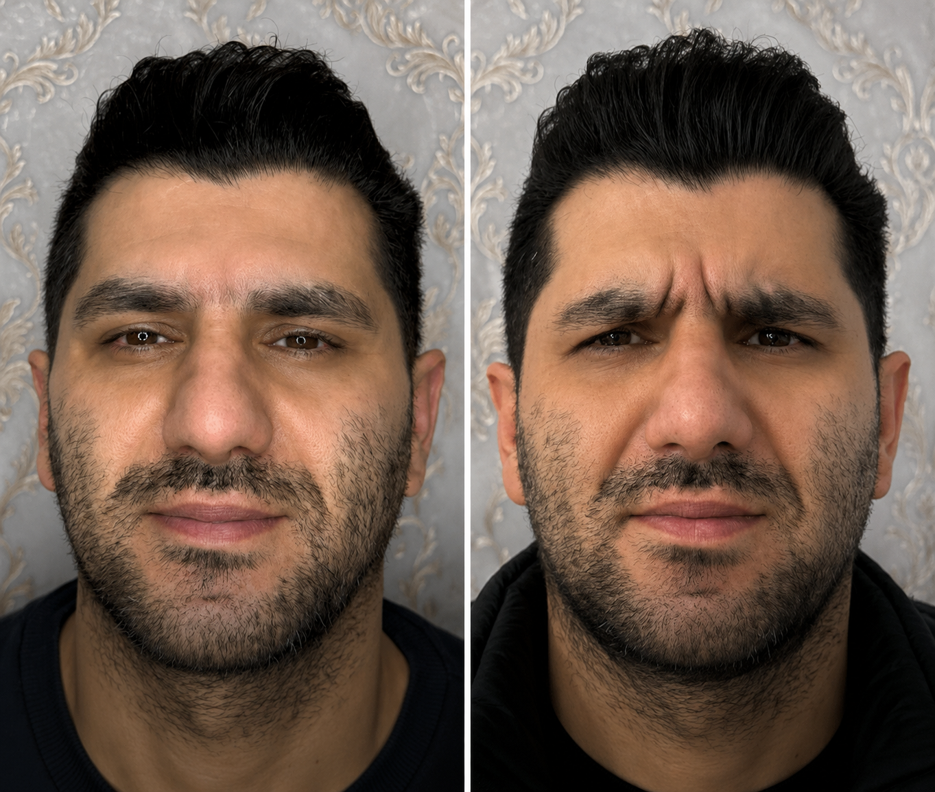 بوتاکس