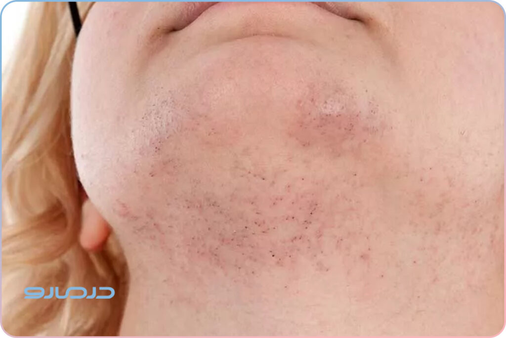 تاثیرات هورمونی